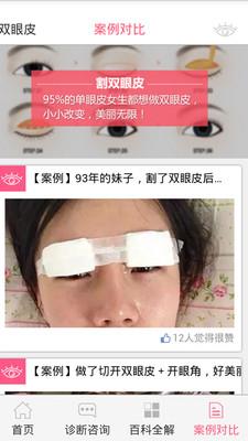 双眼皮咨询APP